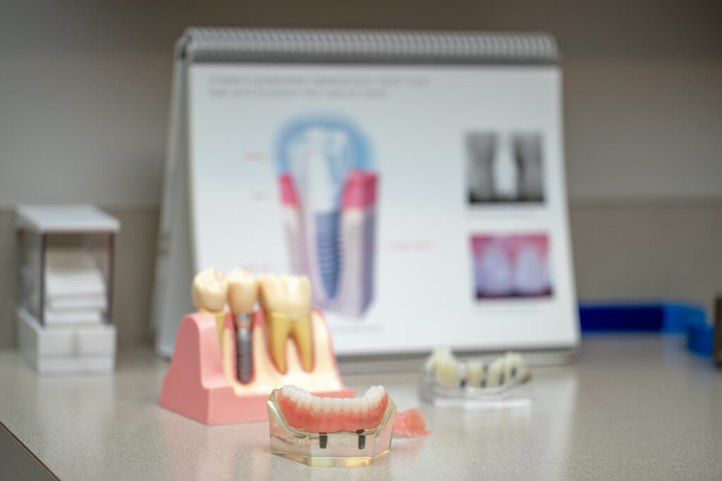 charts and dental molds containing dental implants and dentures at Associated Oral & Implant Surgeons