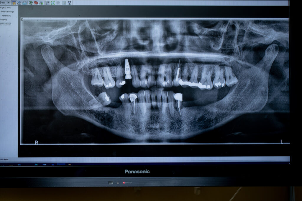 Dental x-ray showing a dental implant and other dental work at Associated Oral & Implant Surgeons