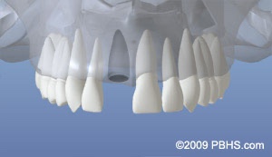 graphic of teeth with one missing or lost adult tooth and hole where the root was
