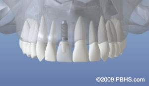 graphic of teeth including a normal restored dental implant