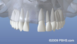 graphic of teeth with a space with missing tooth but the bone healed where the root was previously