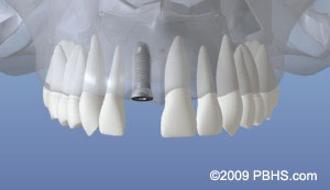 graphic of teeth with the implant placed and healing