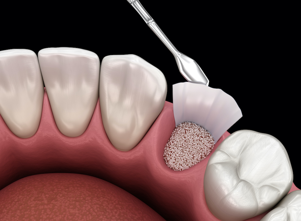 graphic of the back of bottom teeth with one tooth that has received bone grafting at Associated Oral & Implant Surgeons