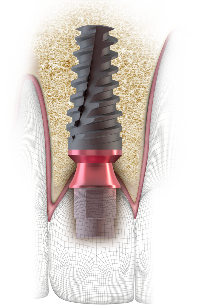 dental implant tool at Associated Oral & Implant Surgeons
