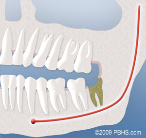 a graphic of the side view of a mouth with a dry socket, a common complication following oral surgery