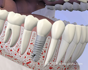 graphic of teeth and roots with a dental implant