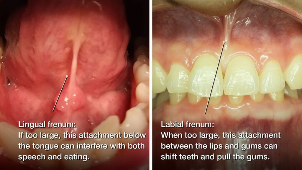 Lingual frenum image stating if too large, this attachment below the tongue can interfere with both speech and eating, and an image of labial frenum stating that when too large, this attachment between the lips and gums can shift teeth and pull the gums