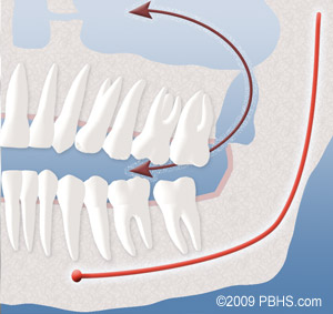 graphic of teeth and jaw with arrows showing the upper wisdom teeth and sinus communication