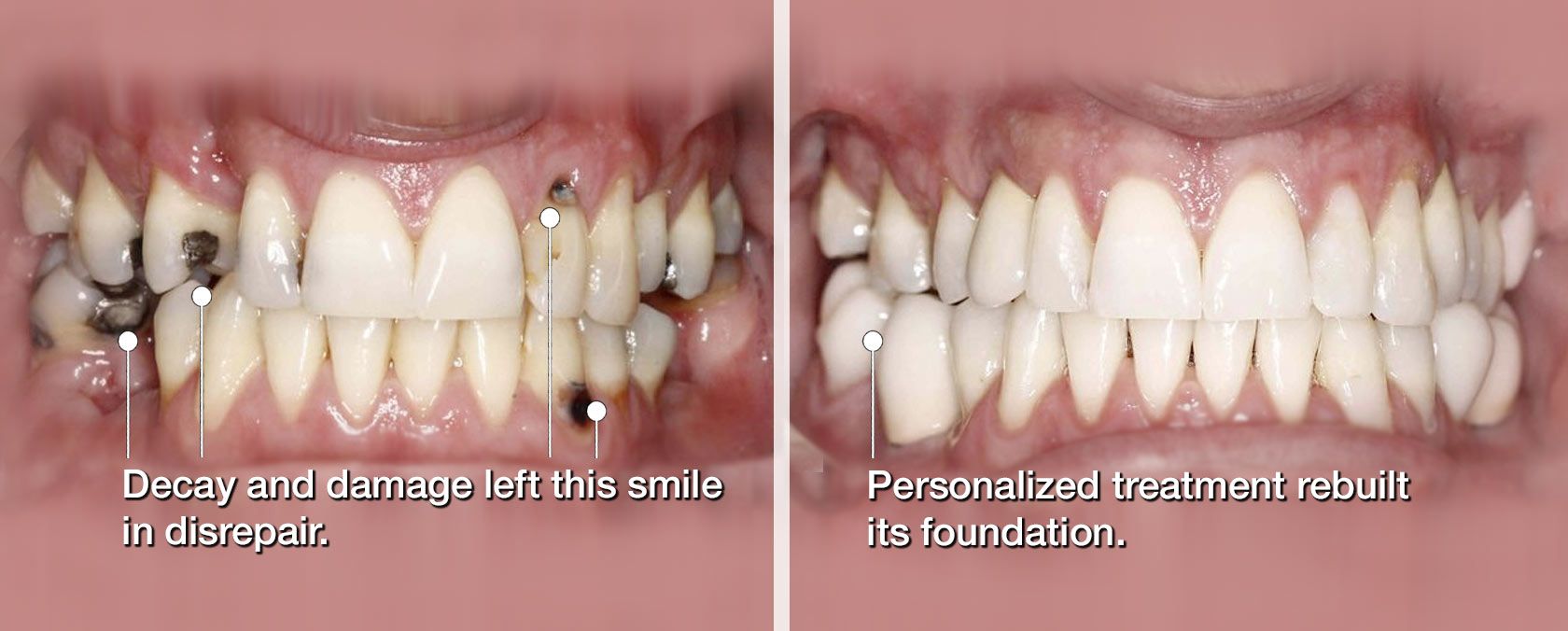 2 photos of mouths one before full mouth reconstruction and one after full mouth reconstruction at Associated Oral & Implant Surgeons
