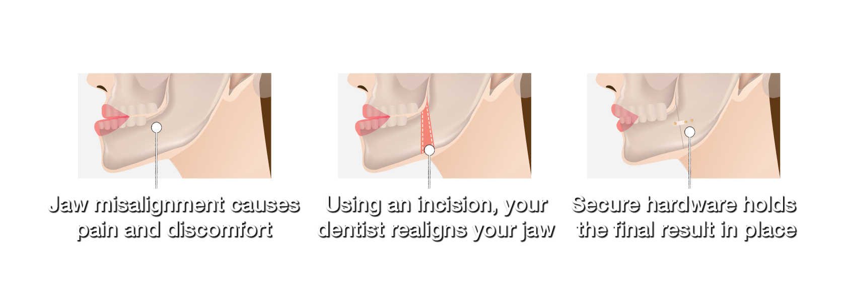 graphic with 3 images showing jaw misalignment, a surgical incision, and surgical hardware holding the jaw in place